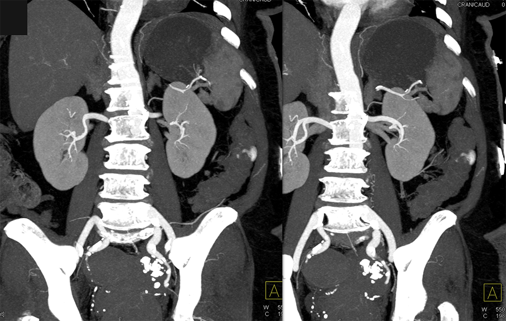 Abdominal Pain and GI Bleeding: ? Etiology