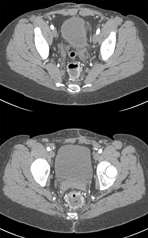 Rectal Enhancement and Bleed Due to Ulcerative Colitis 