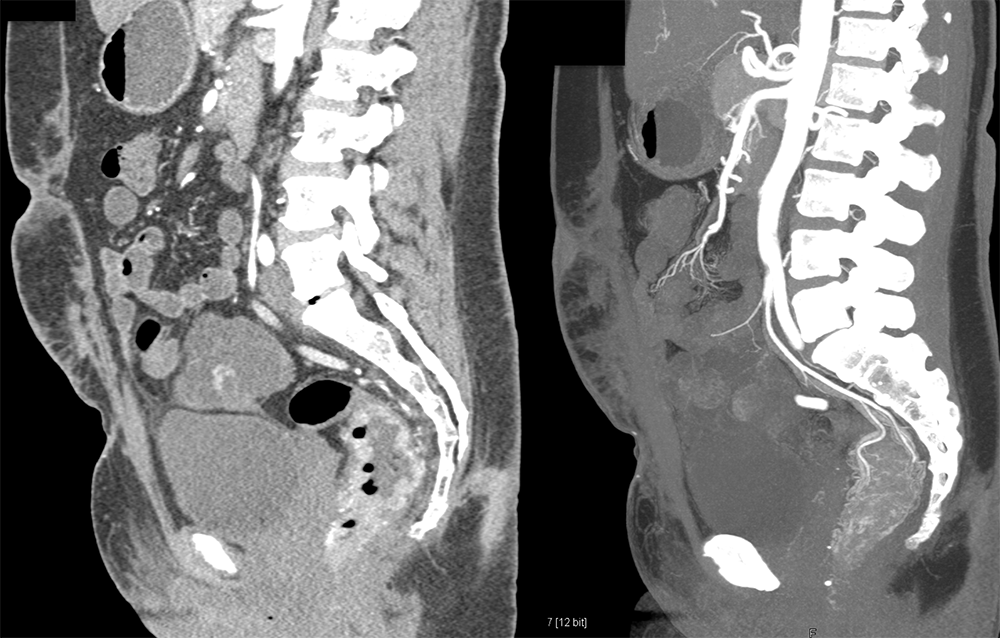 Rectal Enhancement and Bleed Due to Ulcerative Colitis 