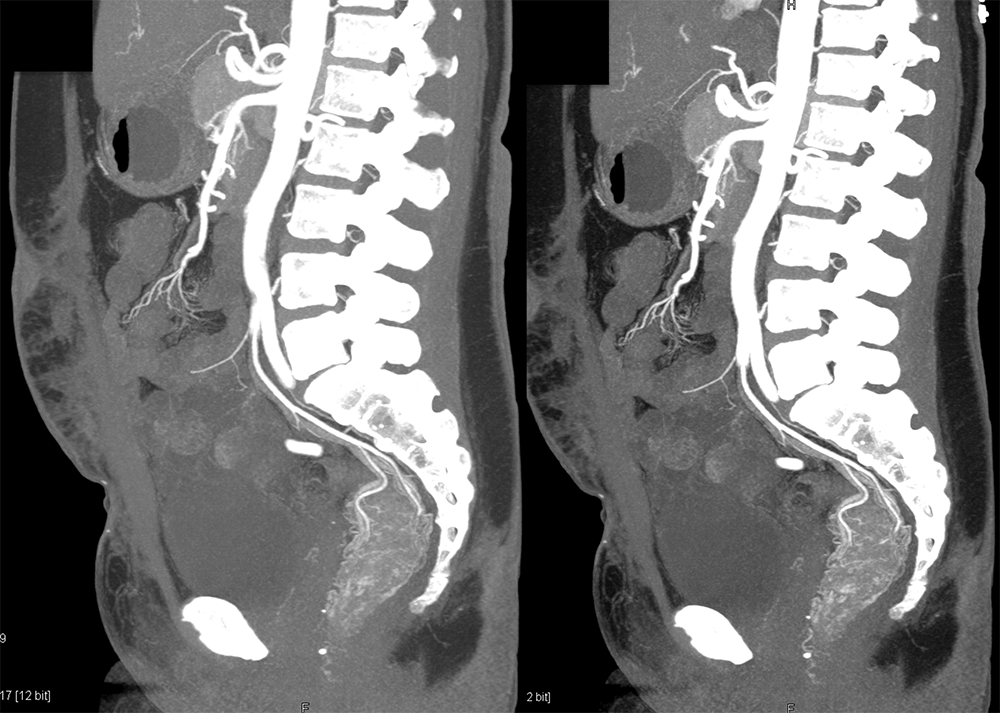 Rectal Enhancement and Bleed Due to Ulcerative Colitis 