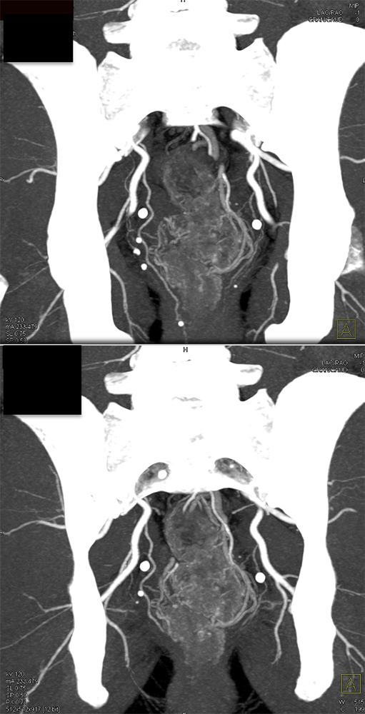 Rectal Enhancement and Bleed Due to Ulcerative Colitis 