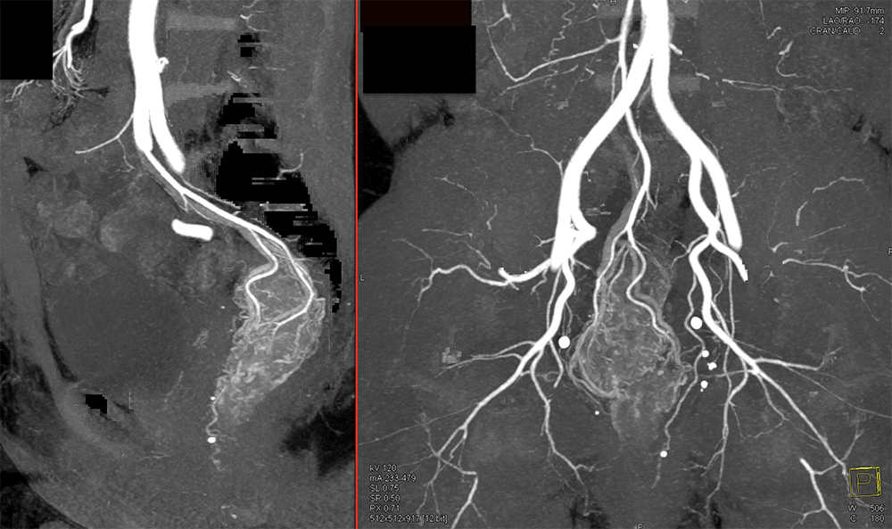 Rectal Enhancement and Bleed Due to Ulcerative Colitis 