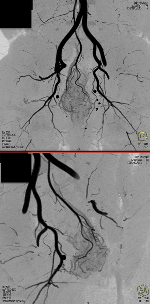 Rectal Enhancement and Bleed Due to Ulcerative Colitis 