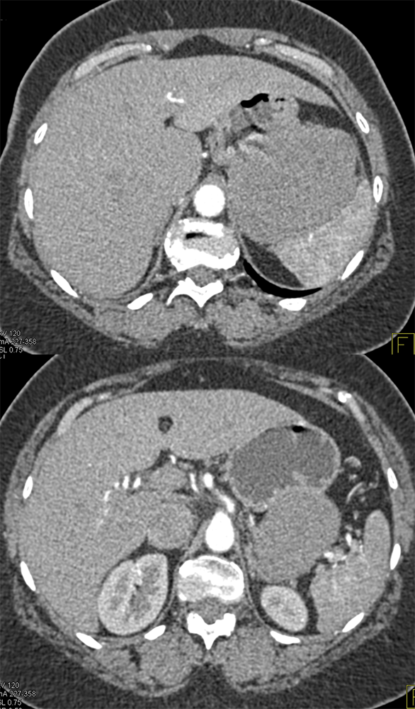 CT of the Adrenal Mass