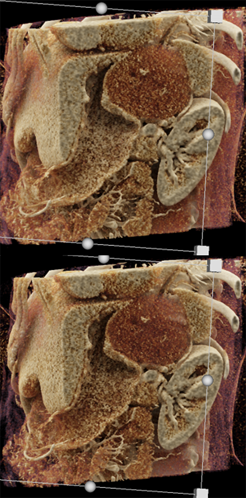 Pitfall: Gastric GIST Tumor Presented as an Adrenal Mass