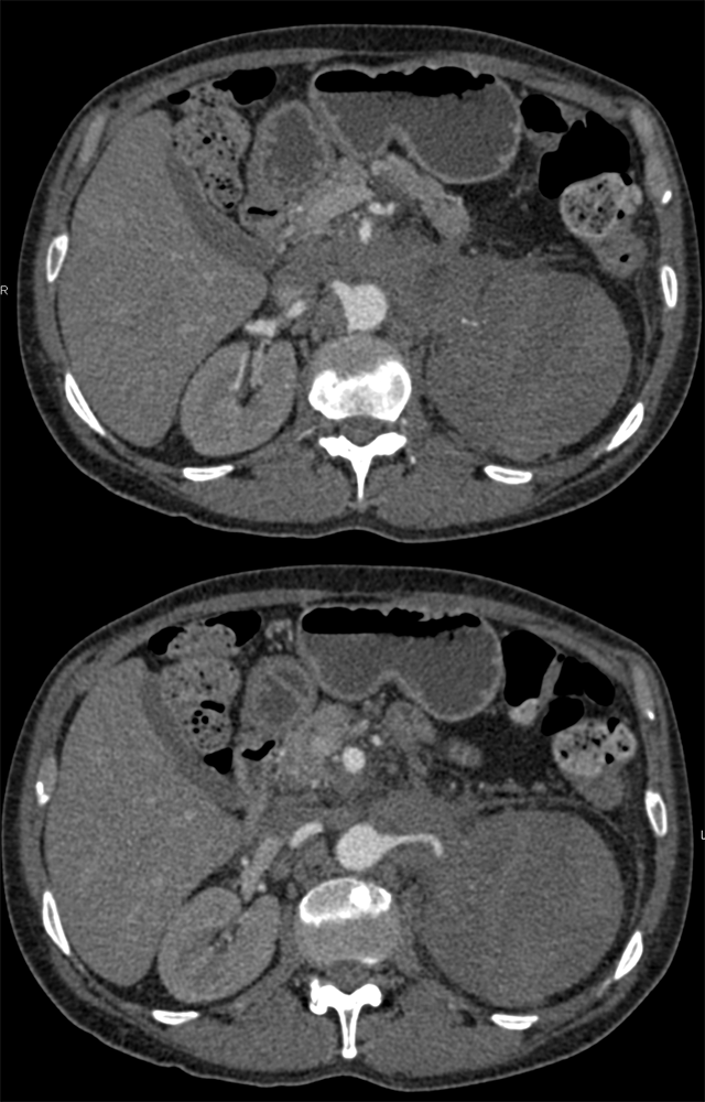 CT of the Adrenal Mass