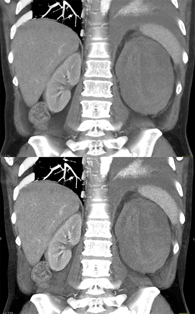 CT of the Adrenal Mass