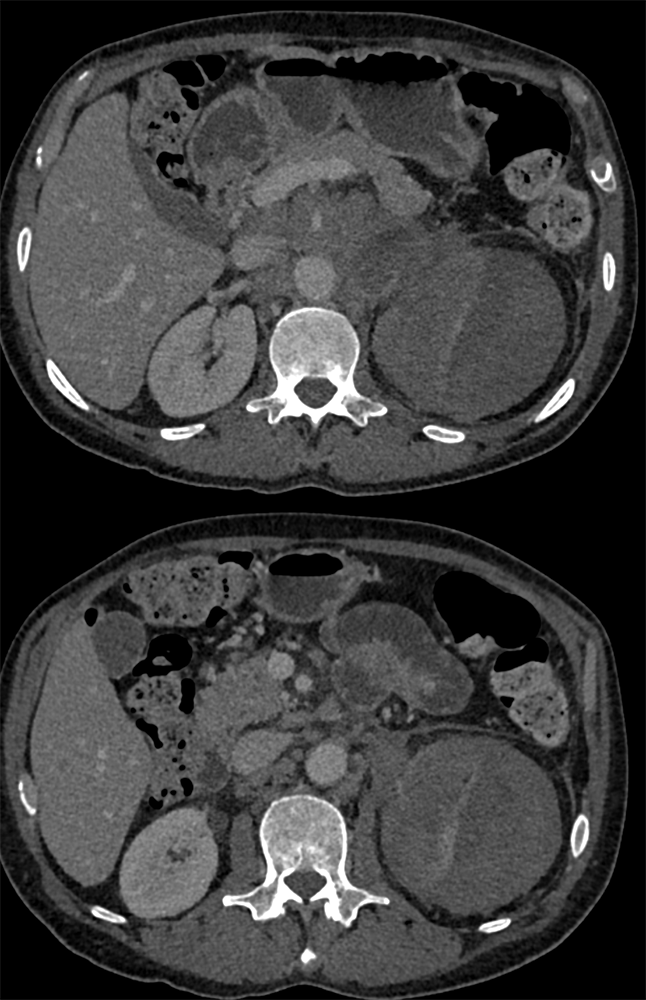 CT of the Adrenal Mass