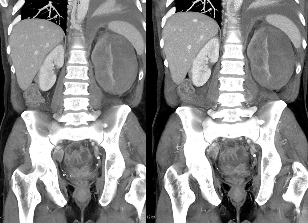 CT of the Adrenal Mass