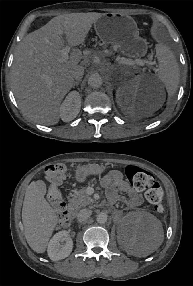 Epitheliod Angiosarcoma of the Left Adrenal Gland