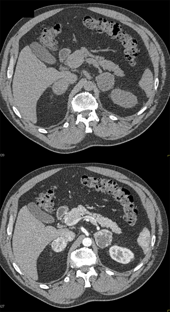 Metastatic RCC to Adrenals