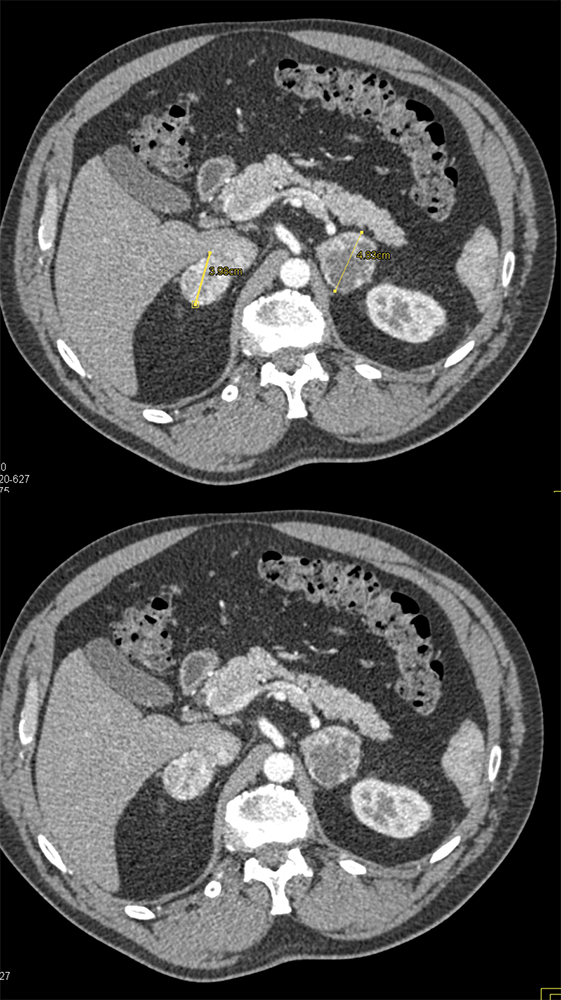 CT of the Adrenal Mass