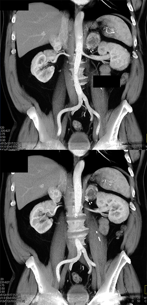 CT of the Adrenal Mass