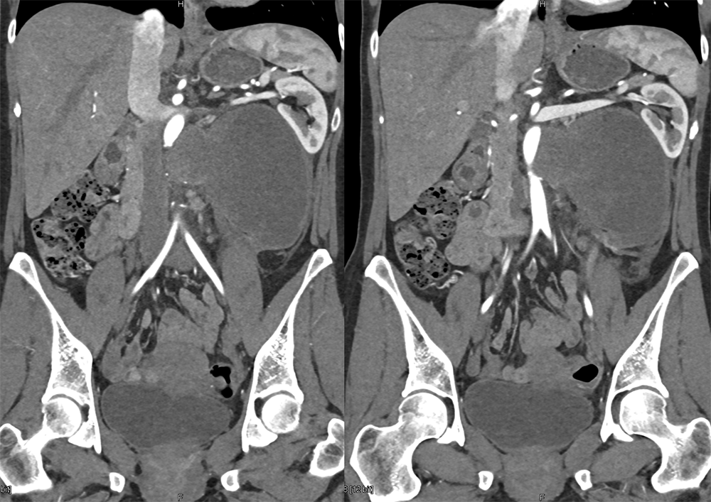 CT of the Adrenal Mass