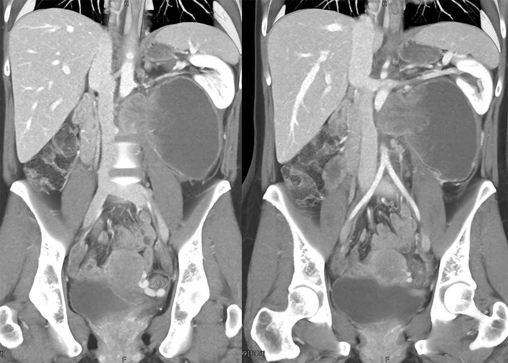 CT of the Adrenal Mass