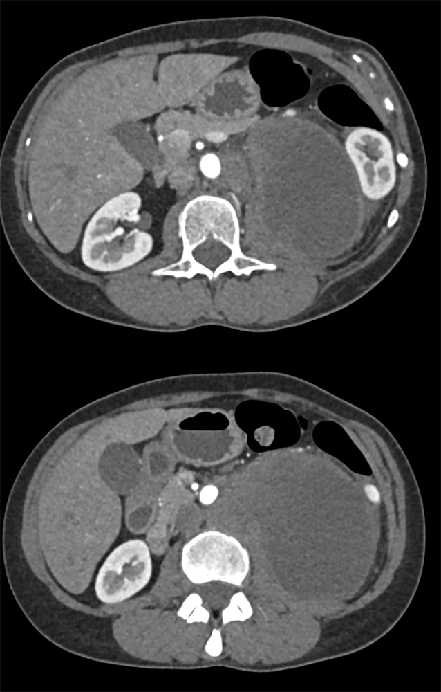 Metastatic Melanoma