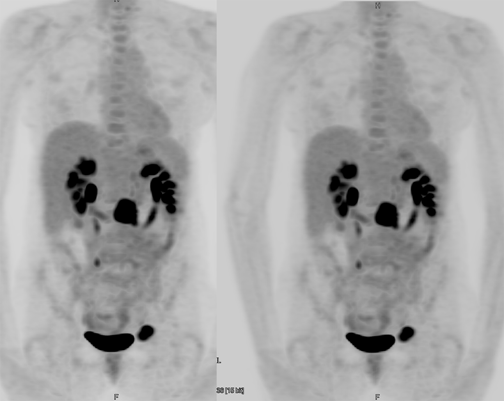 CT of the Adrenal Mass