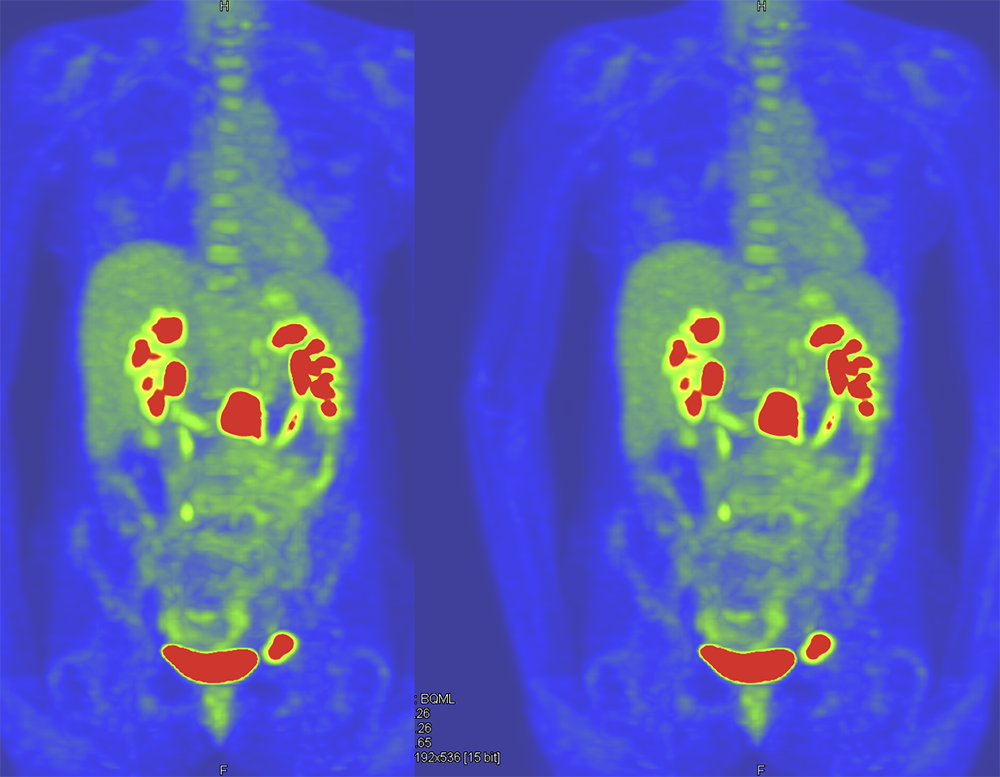 CT of the Adrenal Mass