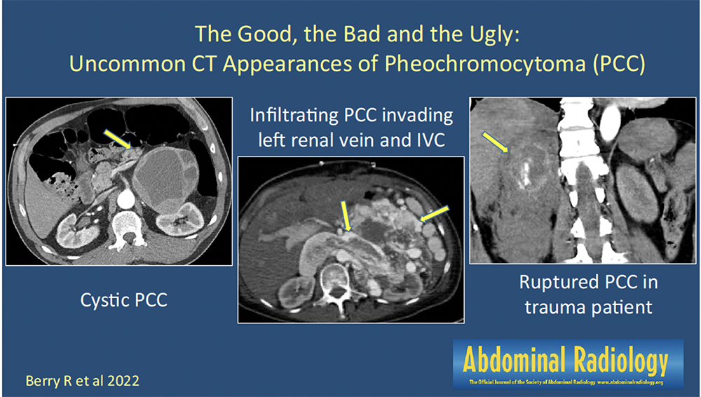 CT of the Adrenal Mass