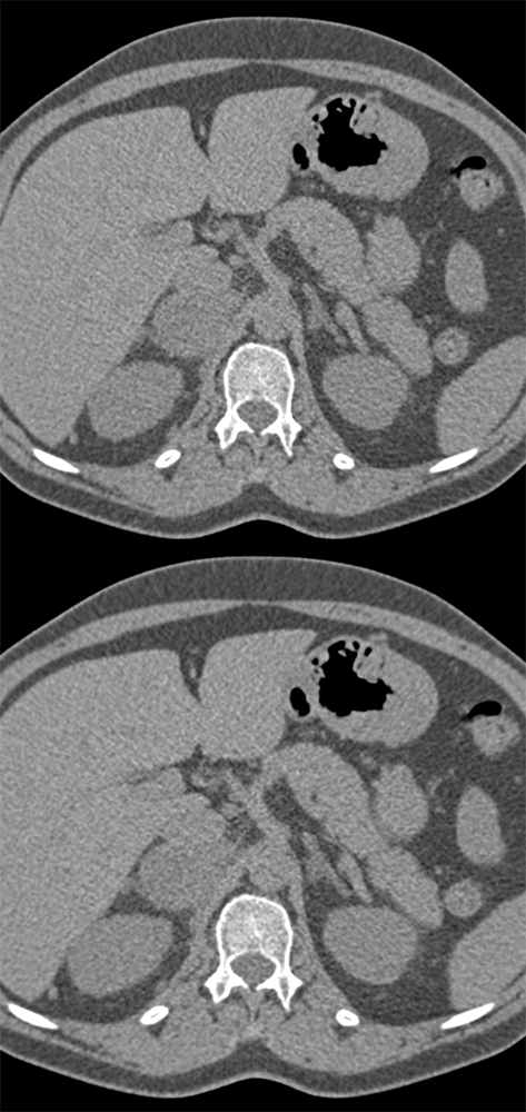 Pheochromocytoma