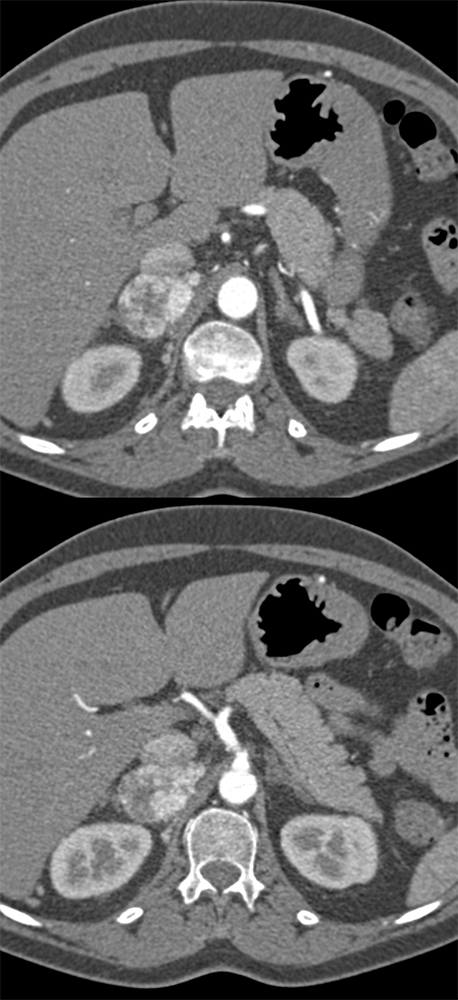 CT of the Adrenal Mass