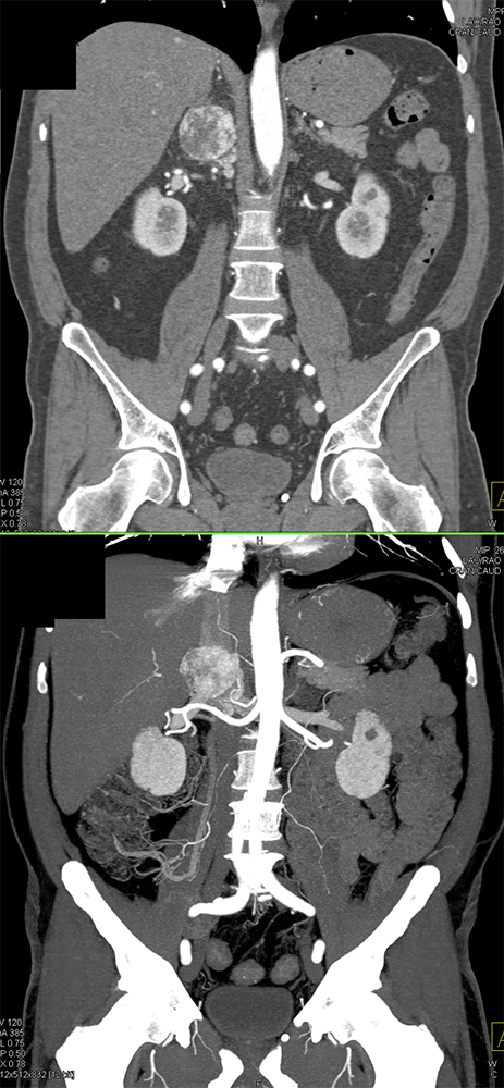 CT of the Adrenal Mass