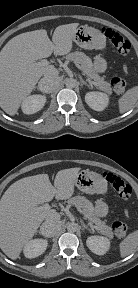 CT of the Adrenal Mass