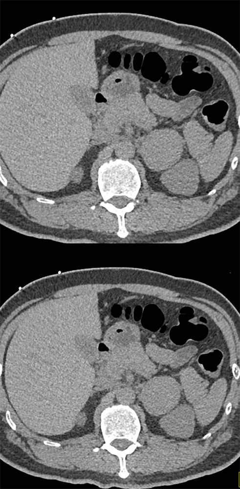 Pheochromocytoma Presents as an Incidentaloma