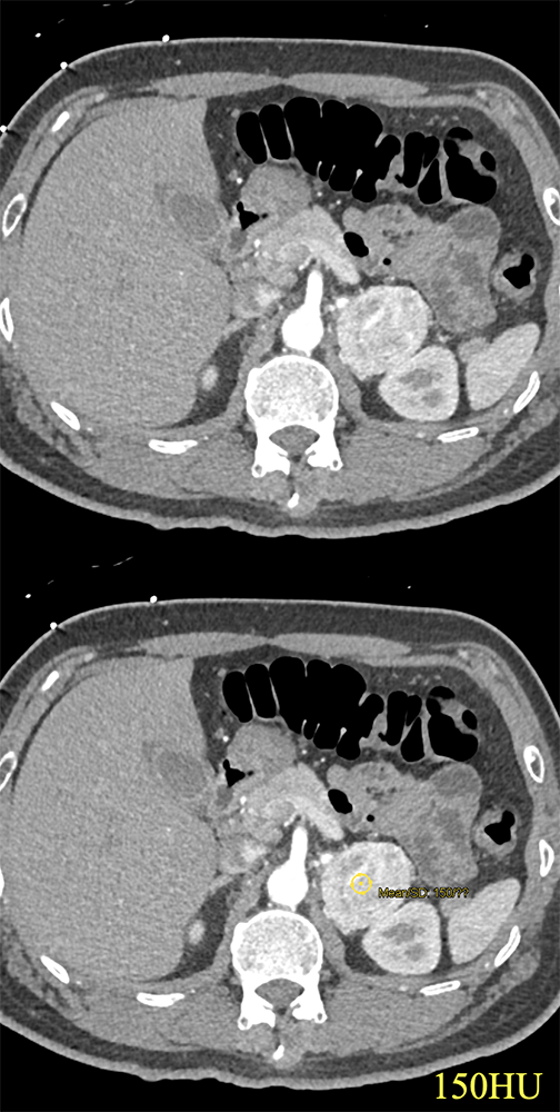 CT of the Adrenal Mass