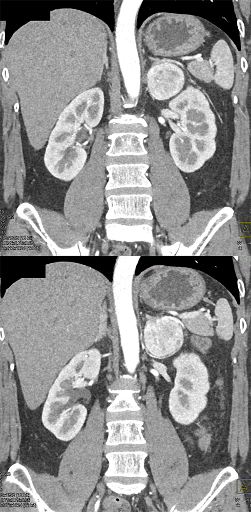 CT of the Adrenal Mass