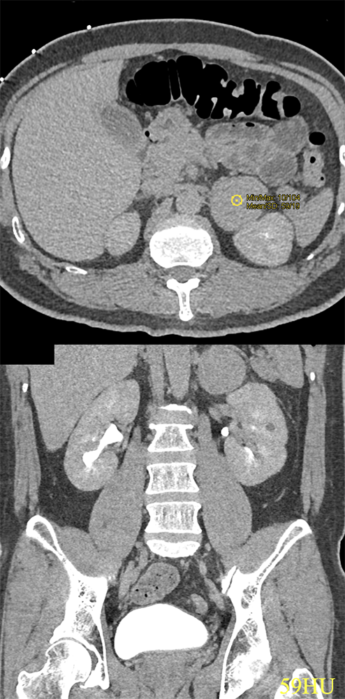 CT of the Adrenal Mass