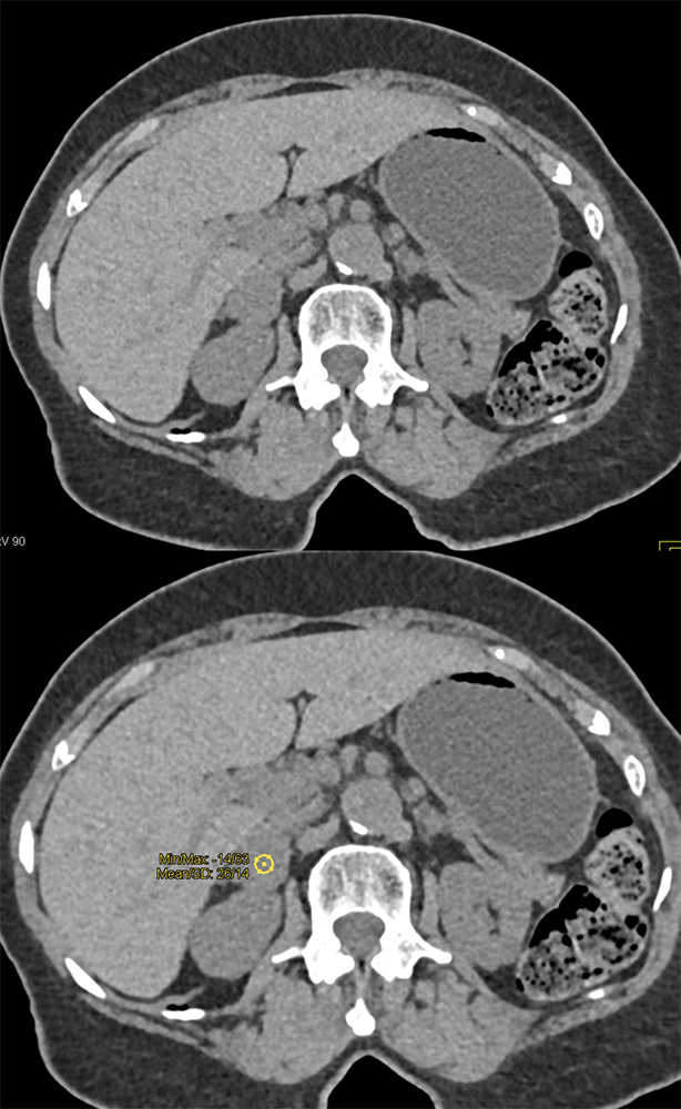 Adrenal Pheo Enhances to 280 HU