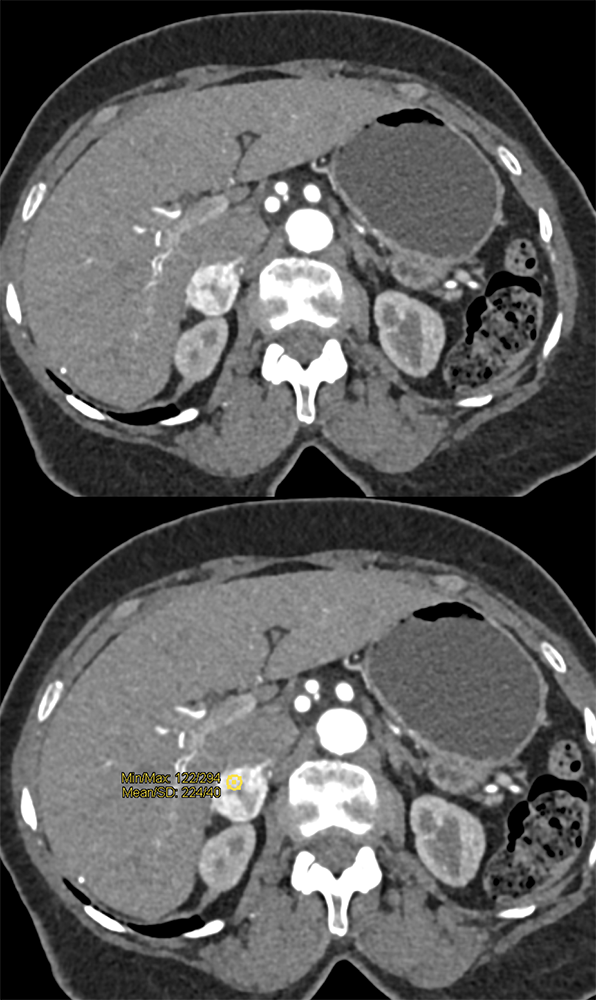 CT of the Adrenal Mass