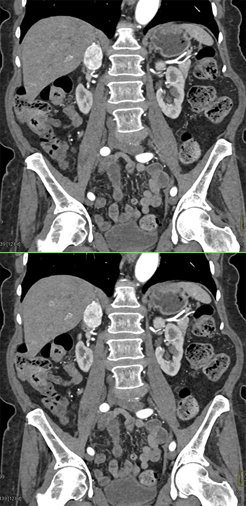 CT of the Adrenal Mass