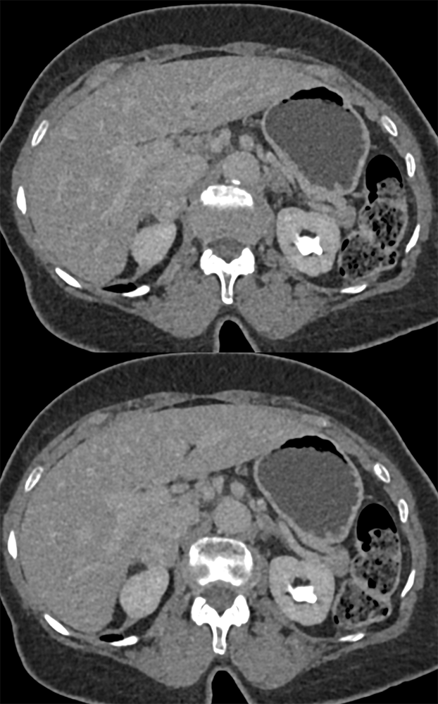 CT of the Adrenal Mass