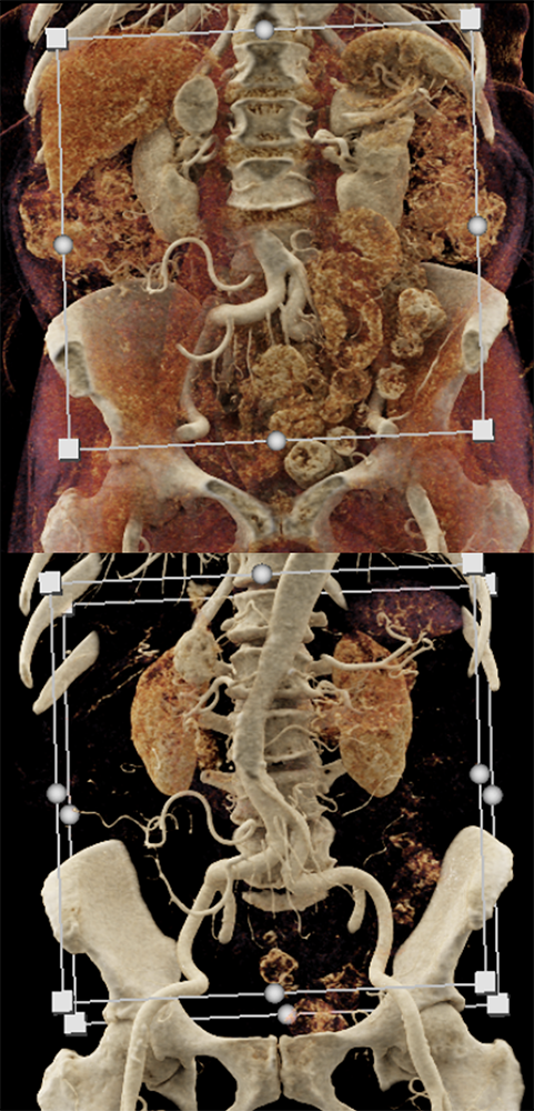 CT of the Adrenal Mass