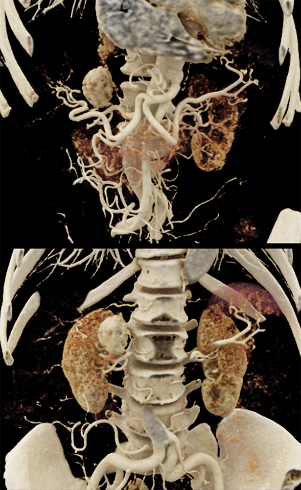 CT of the Adrenal Mass