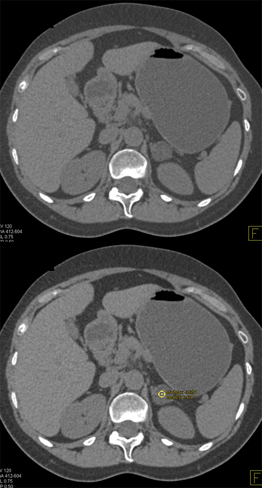 Adrenal Adenoma Noncontrast is 6HU