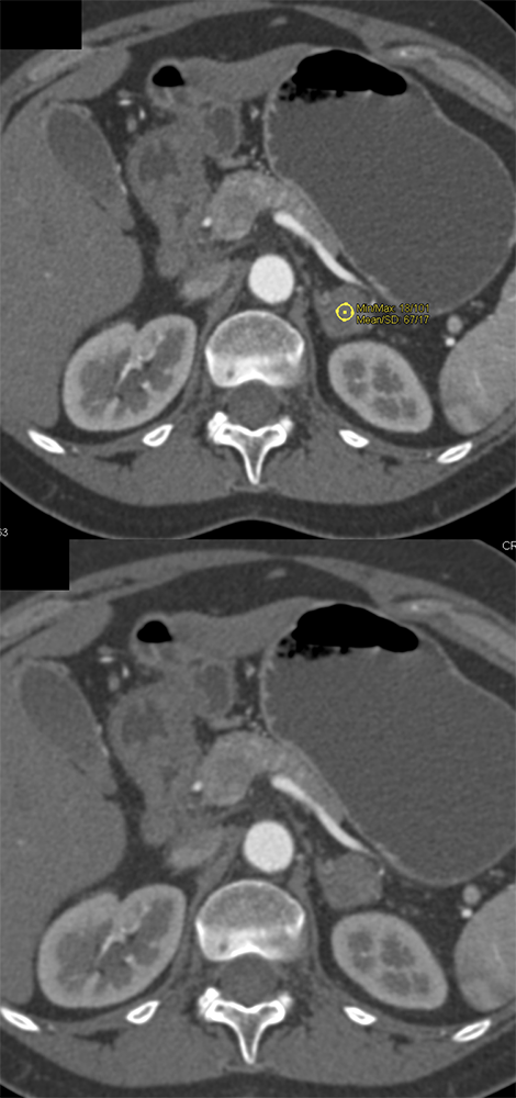 Arterial Phase is 67HU