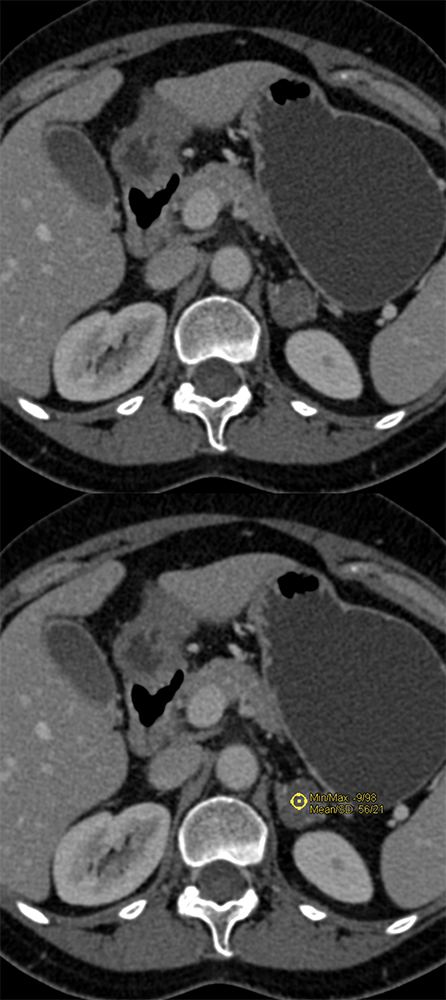 Venous Phase is 56HU