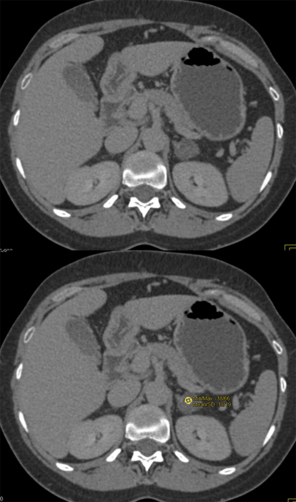 Delayed Scan is 18 HU