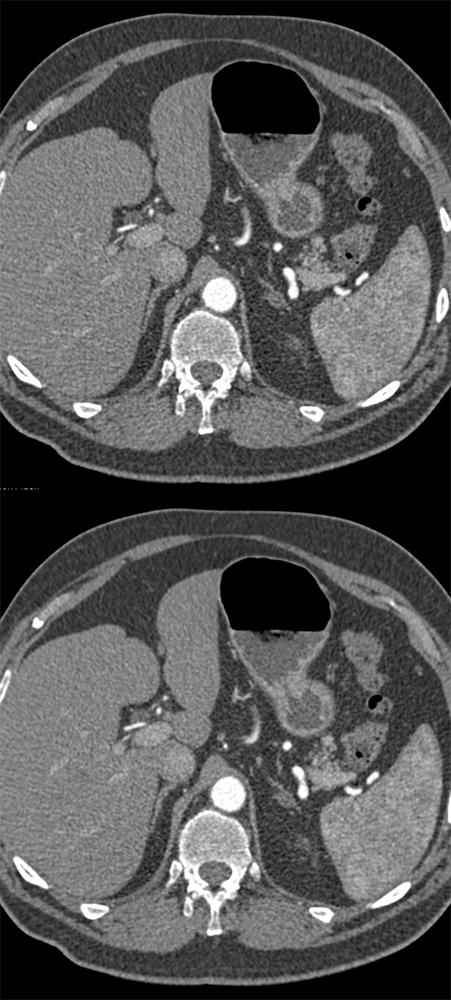 Hypertensive; r/o Dissection