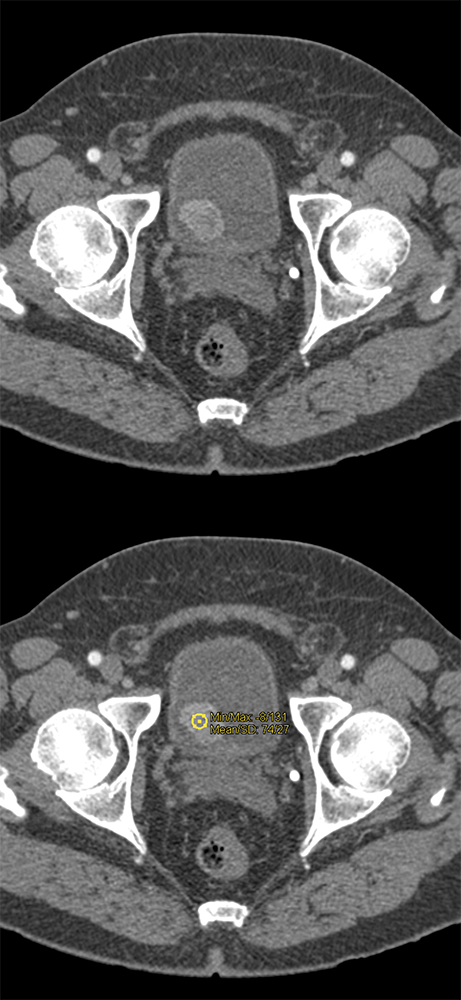 CT of the Adrenal Mass