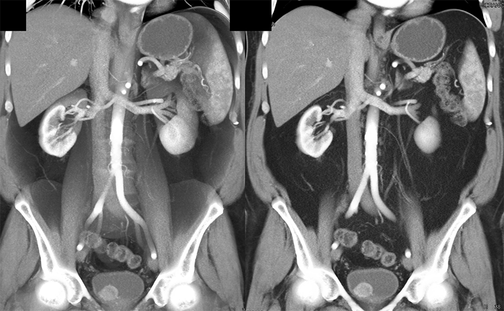 CT of the Adrenal Mass