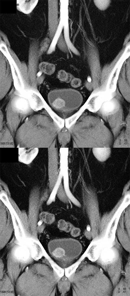 CT of the Adrenal Mass