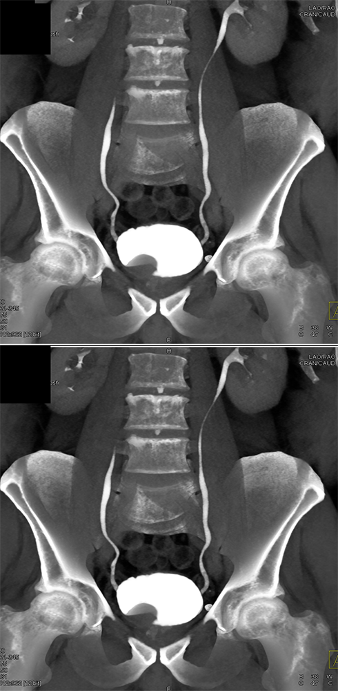 CT of the Adrenal Mass