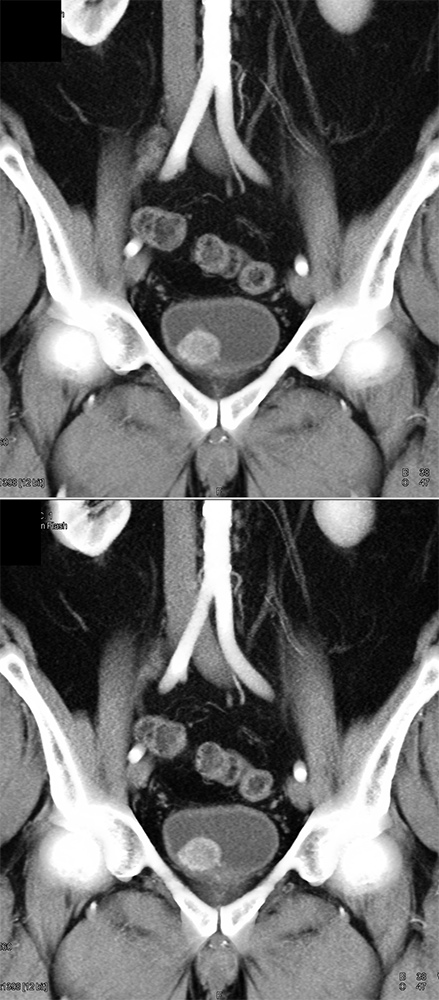 CT of the Adrenal Mass