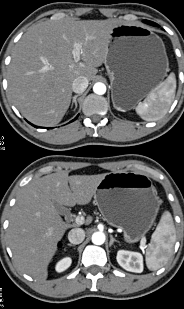 Normal Adrenal Glands