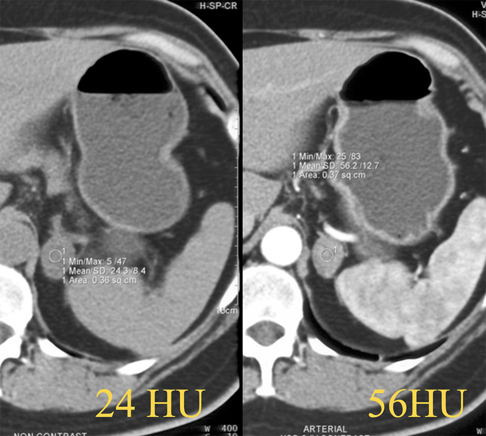 CT of the Adrenal Mass