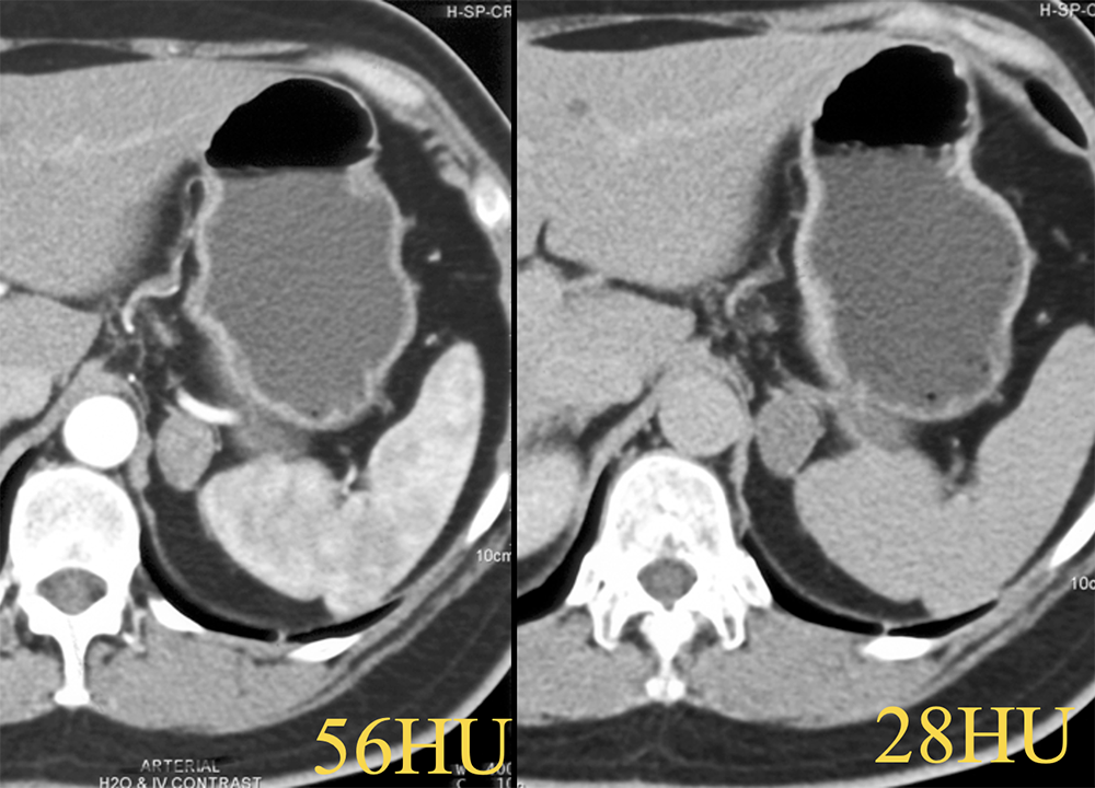 Fat Poor Adrenal 